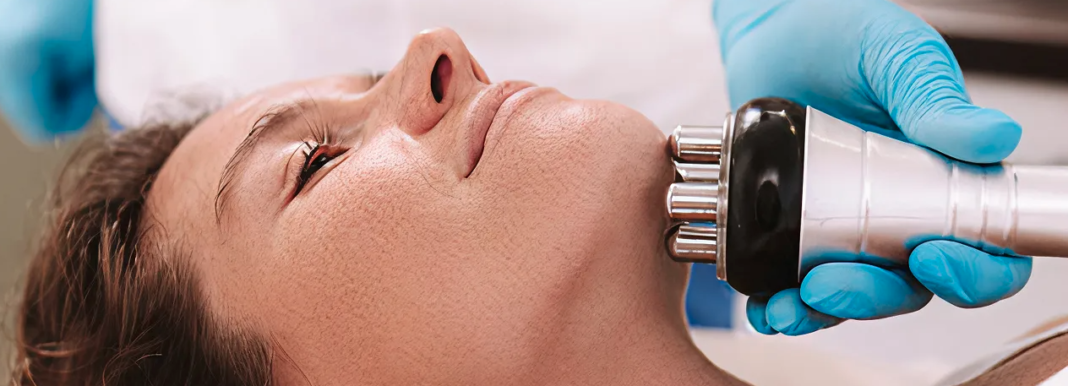 radio frequency facial
